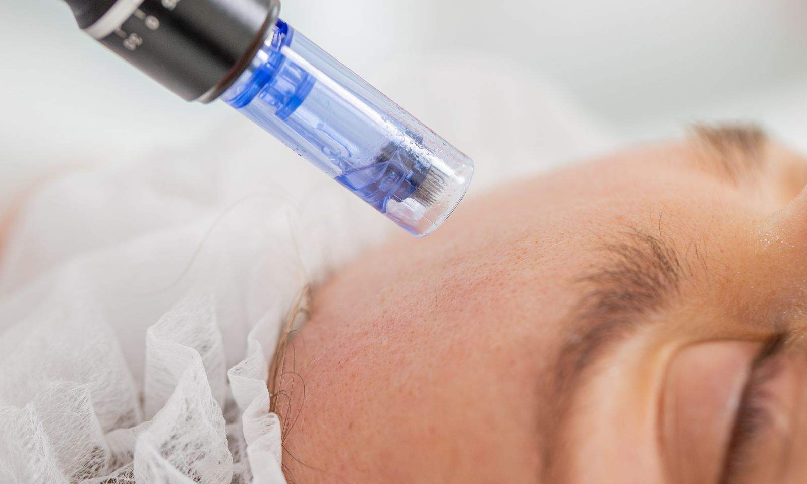 Microneedling Certification
