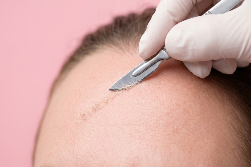 Dermaplaning Express