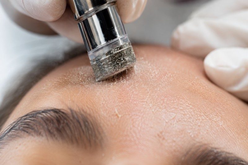 Microdermabrasion Express