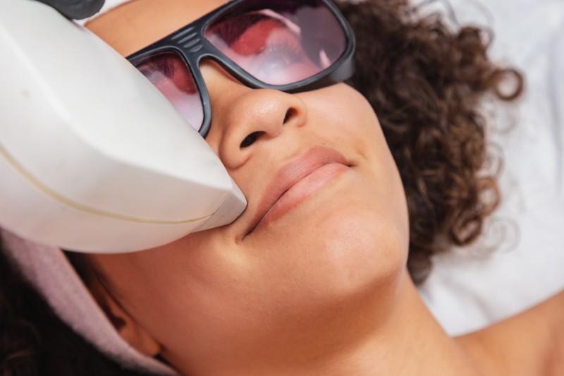 Laser Hair Removal – Lip & Chin